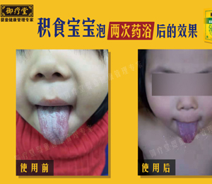 御療堂藥浴積食寶寶對比舌苔 1